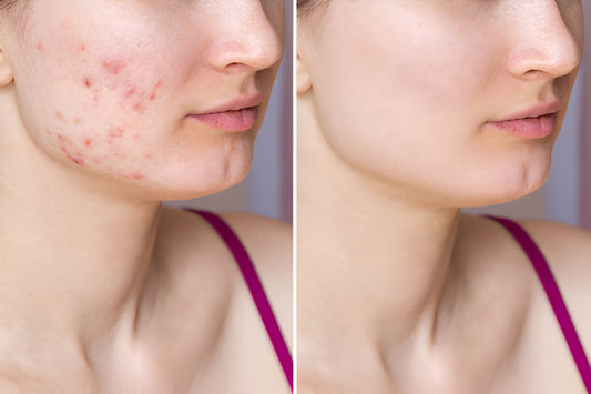 Kompletter K-Beauty-Leitfaden: Wie man mit Akne und Narben umgeht + Top-Inhaltsstoffe und Produkte-Wonder Skin
